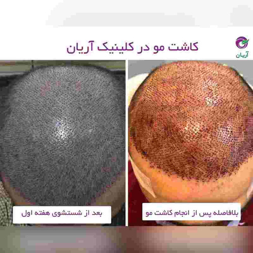 گالری کاشت مو 